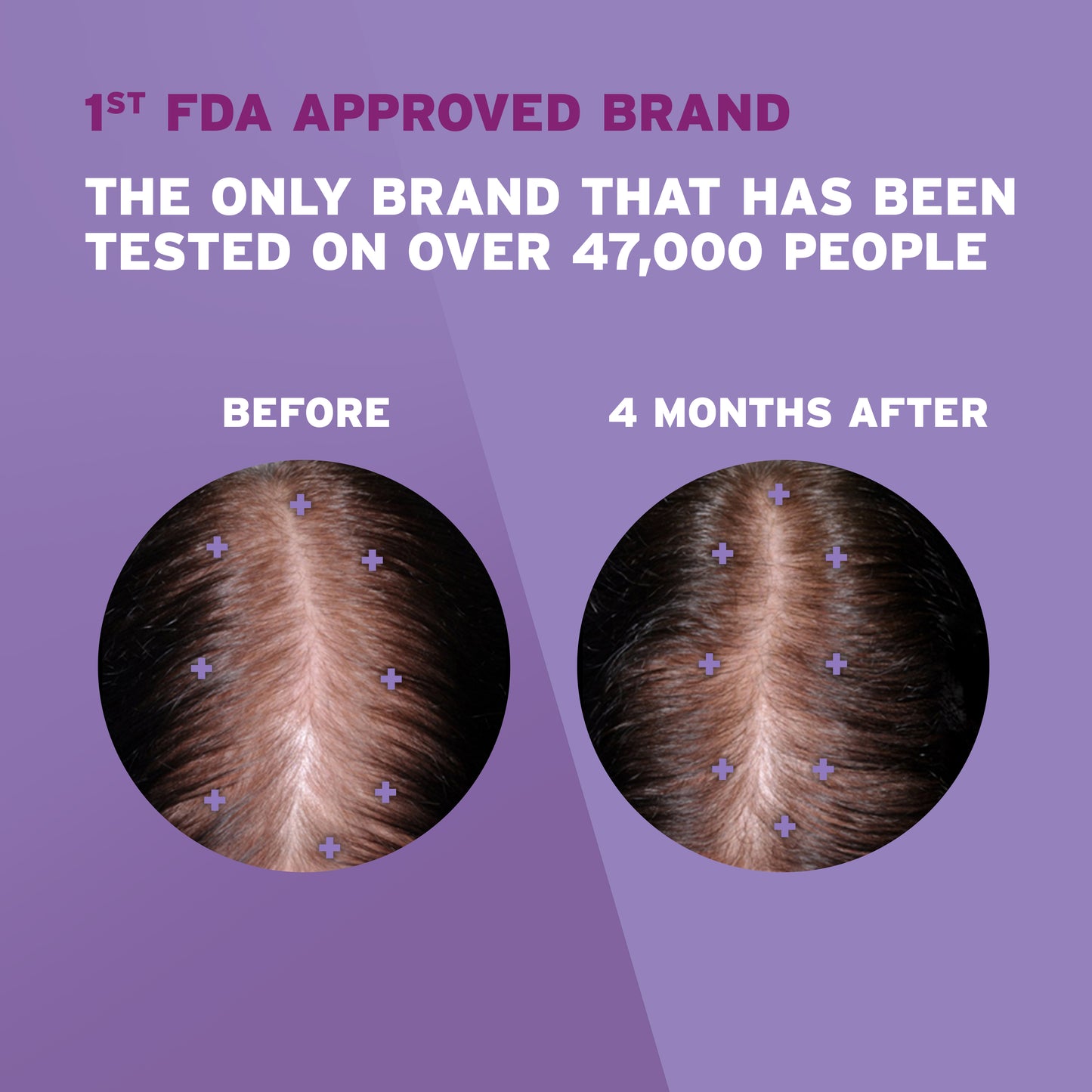 A woman with brown hair showing hair regrowth after 4 months of use, on a purple background.